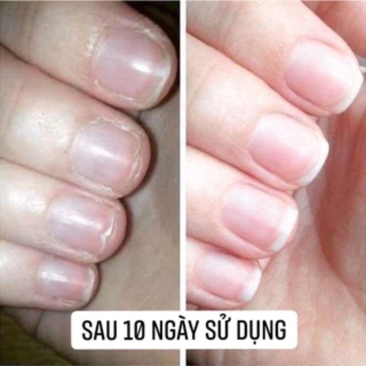 Collagen Nail Care Helps Nails Grow Fast - Strong, Shiny, Pink - Restores Weak Nails